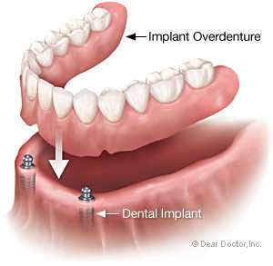 Why use implant overdenture at Andersen Dental Center in Vancouver WA