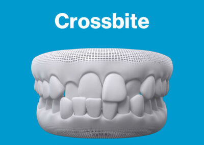 Invisalign Crossbite Smile