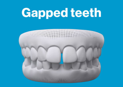 Invisalign Gapped Teeth Smile