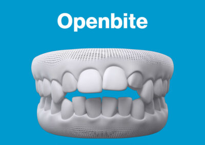 Invisalign Openbite Smile